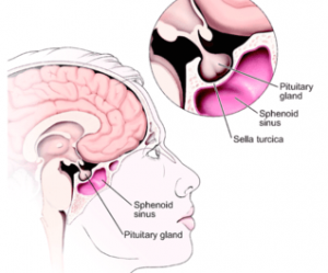 Pituitary Tumors Surgery