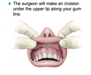 Pituitary Tumors surgery procedure